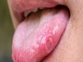 لايف ستايل7 علامات تشير للإصابة بسرطان الفم يجب عدم تجاهلها أبرزها صعوبة البلع